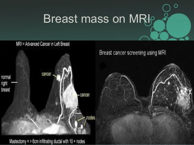 mri breast mass Mri breast mass